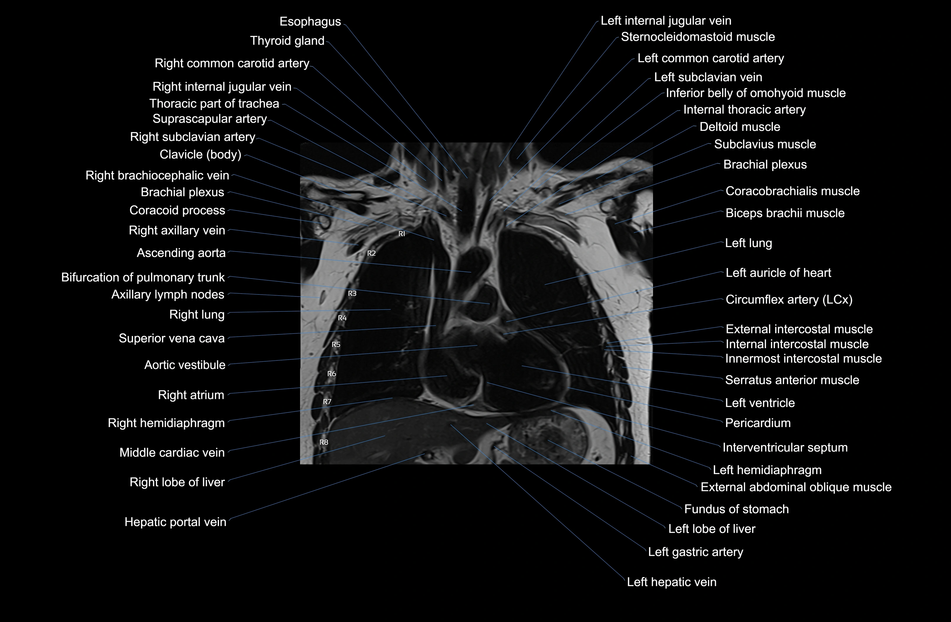 MRI chest (thorax) coronal  cross sectional anatomy 3T radiology  image-img-00001-00018.webp